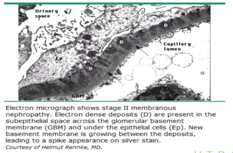 spike and dome appearance membranous nephropathy|Primary membranous nephropathy: comprehensive review and.